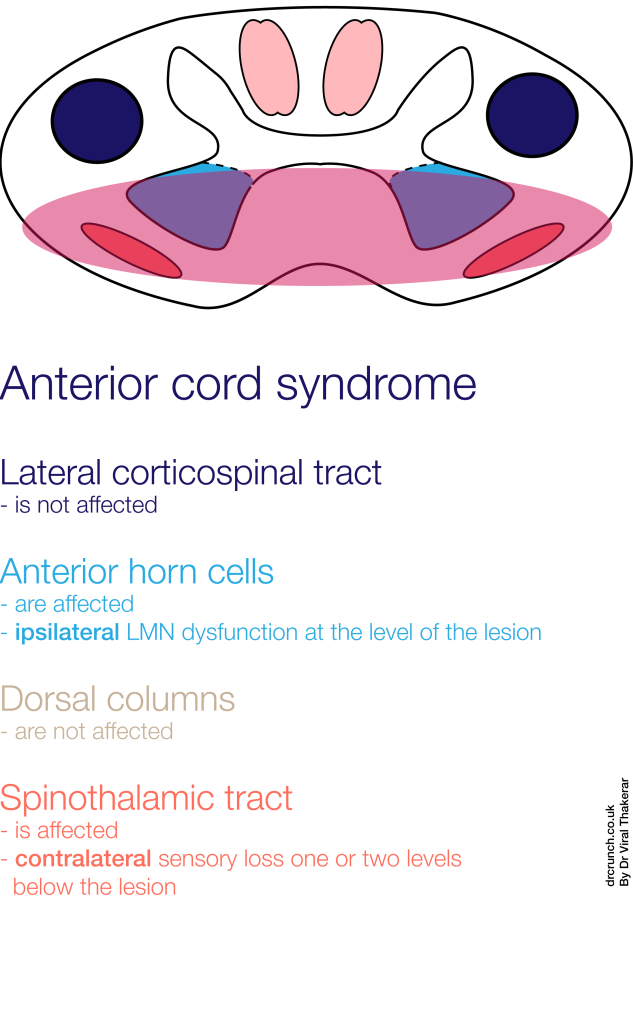 Anterior Cord Syndrome simplified.