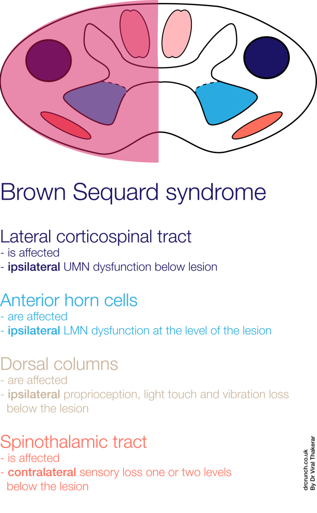 The Brown Sequard syndrome
